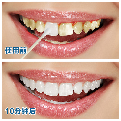 牙斑净牙齿美白白牙素速效美牙去黄牙烟牙茶渍洗牙水漂白洁白牙贴