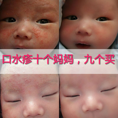 艾裕婴儿口水疹无激素特效止痒新生儿口水疹 宝宝红屁股尿布疹
