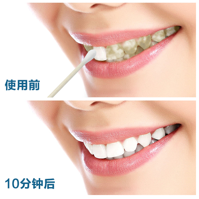 牙斑净牙齿美白白牙素速效美牙去黄牙烟渍茶渍洗牙水漂白洁白牙贴
